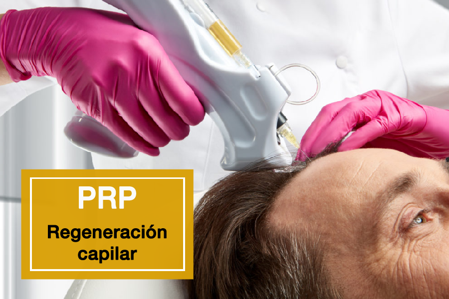 Plasma Rico en Plaquetas para la regeneración capilar