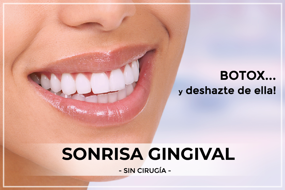 sonrisa gingival botox