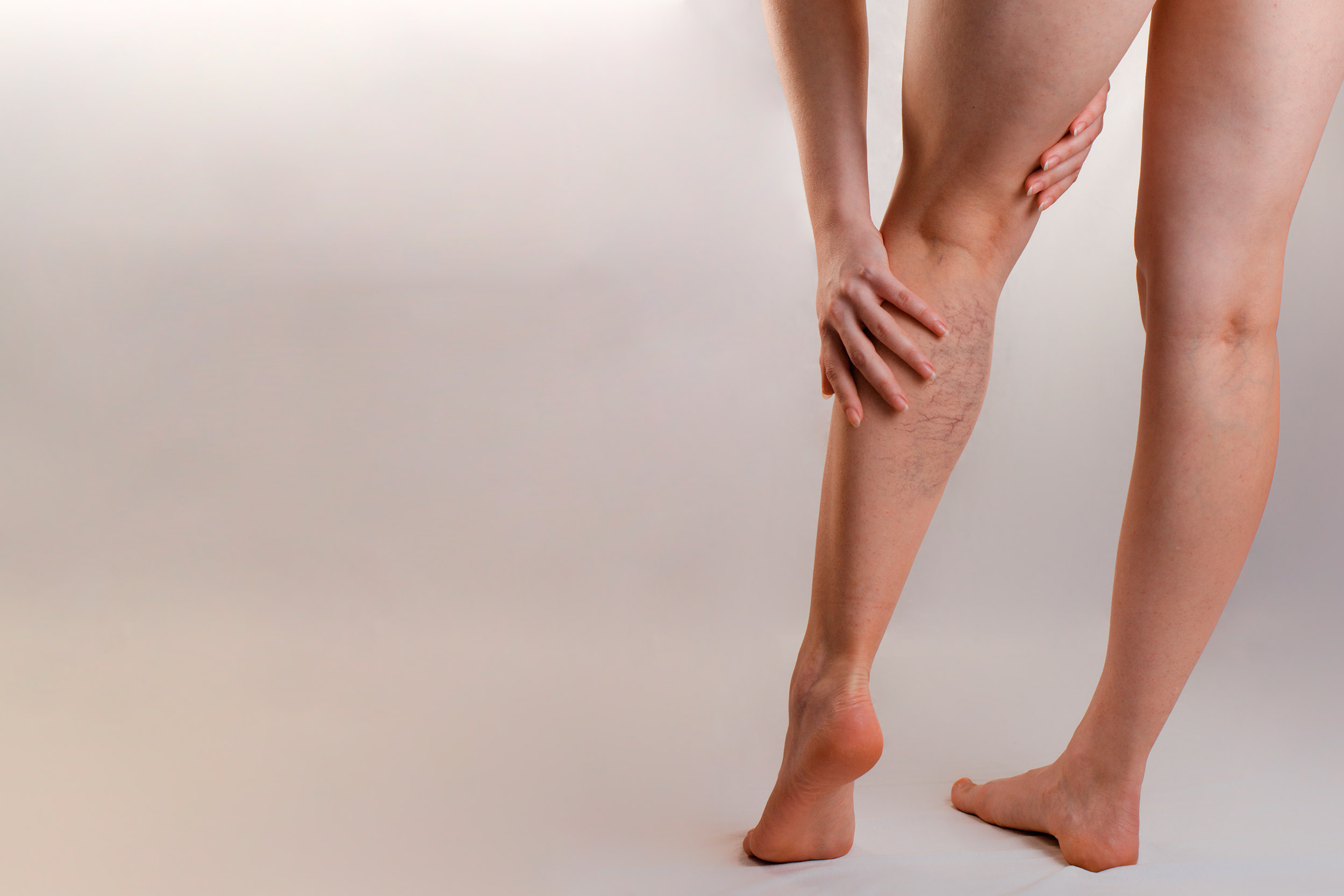 Varices