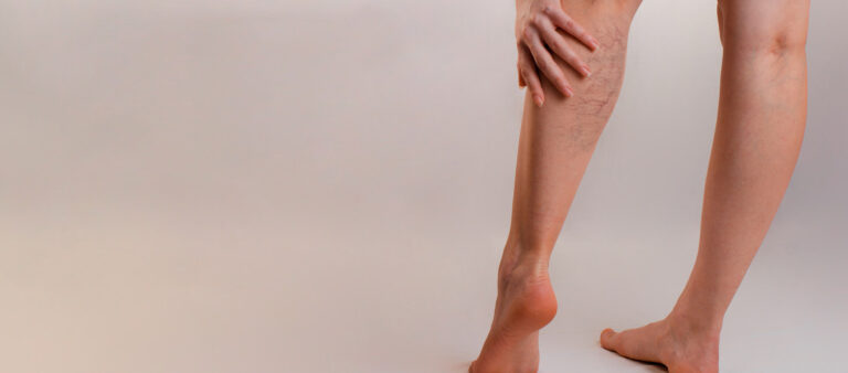 Varices